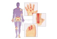 Artrita psoriazică: Tipuri, cauze, simptome și tratamente