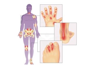 Artrita psoriazică: Tipuri, cauze, simptome și tratamente