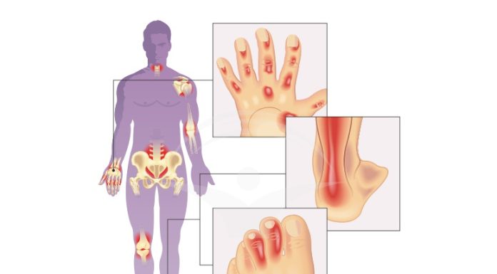 Artrita psoriazică: Tipuri, cauze, simptome și tratamente