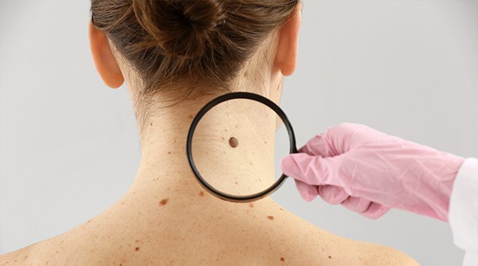 Pete ale pielii pe care ar trebui să le verifici