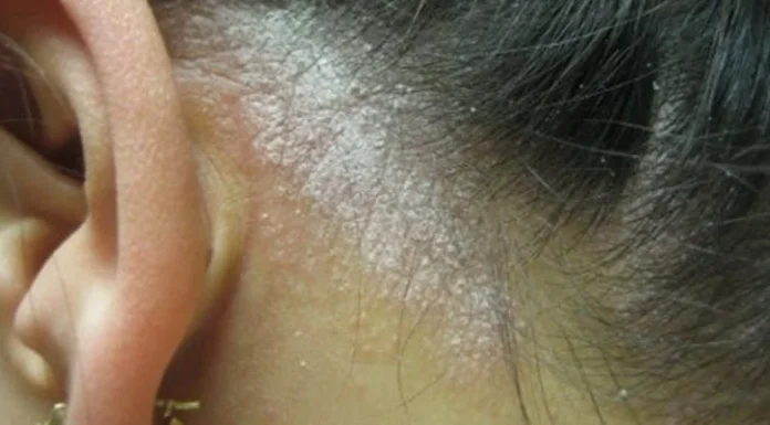 Este matreata sau psoriazisul scalpului? Cum să știe