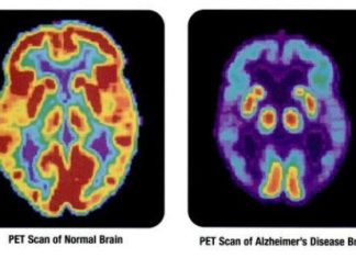 Poate o scanare a creierului să detecteze demența sau Alzheimer?